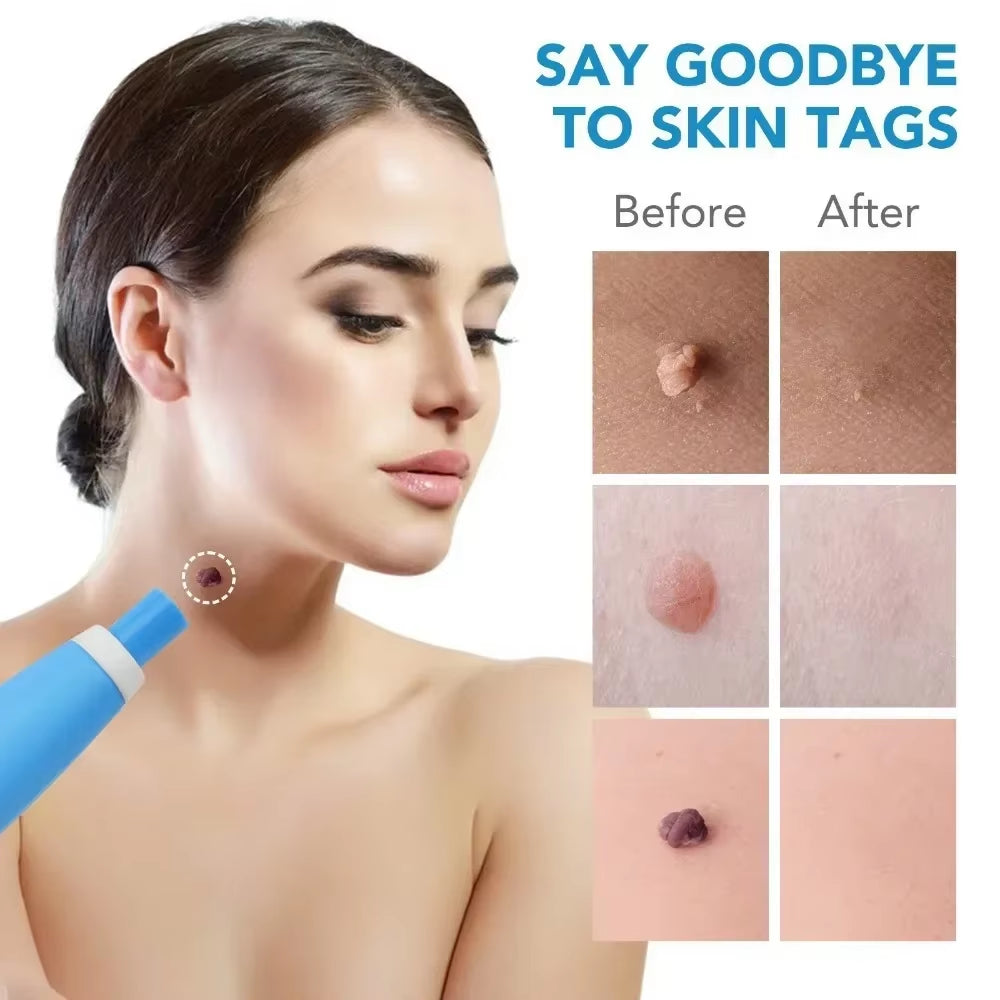 Skin Tag Removal